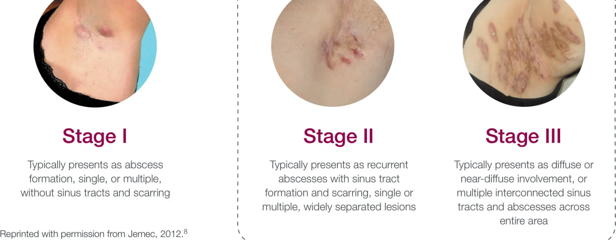 Hurley Stages of Hidradenitis Suppurativa 