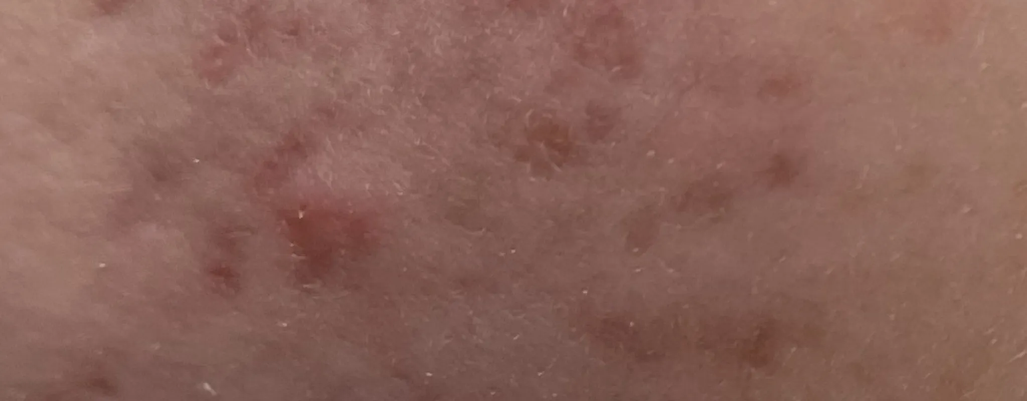 Emma's skin prior to treatment