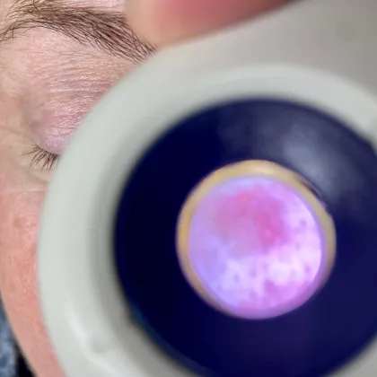 Skin irregularity close up